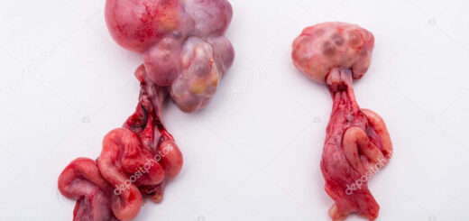 Comment Soigner Naturellement un Kyste Testiculaire ?