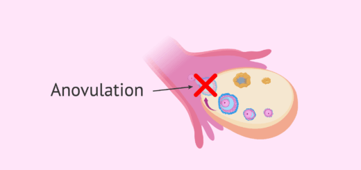 Anovulation Causes Symptômes Traitement Naturel de l' anovulation