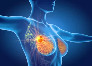 Comment Soigner Naturellement le Cancer du Sein en peu de temps ?