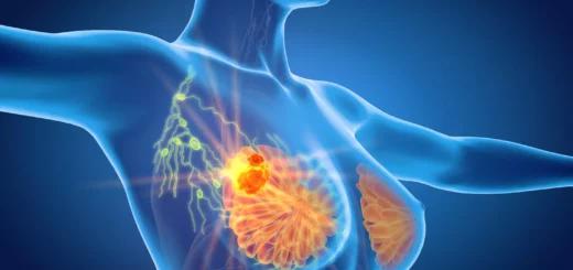 Comment Soigner Naturellement le Cancer du Sein en peu de temps ?