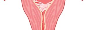 Comment Traiter Naturellement une Synéchie Uterine ?