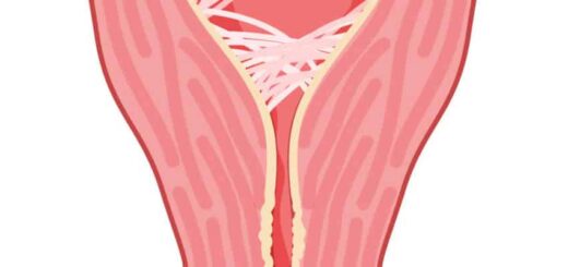 Comment Traiter Naturellement une Synéchie Uterine ?