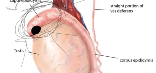 Comment Traiter Naturellement une l'orchi-épididymite en peu de Temps ?