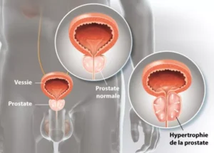 Comment Traiter Naturellement l' Adénome de la Prostate avec les Plantes ?