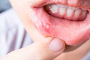 Comment Traiter Naturellement la Syphilis par les Plantes Médicinales ?