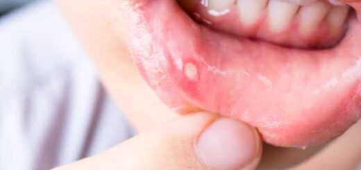 Comment Traiter Naturellement la Syphilis par les Plantes Médicinales ?