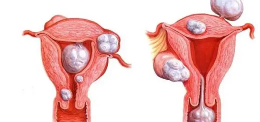 Comment Traiter Naturellement un Fibrome Utérin en peu de Temps ?