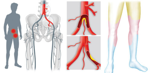 Artériopathies Causes Symptômes Prevention Traitement Naturel