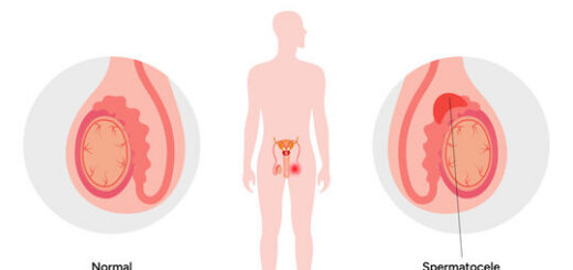 Comment Dissoudre Naturellement un Kyste Testiculaire en peu de Temps ?